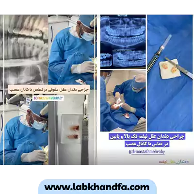 قبل و بعد نمونه کار جراحی دندان عقل دکتر مصطفی مهرابی