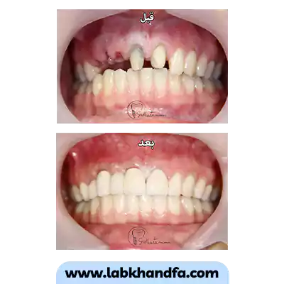 قبل و بعد نمونه کار ایمپلنت دکتر سید محمود خاتمیان