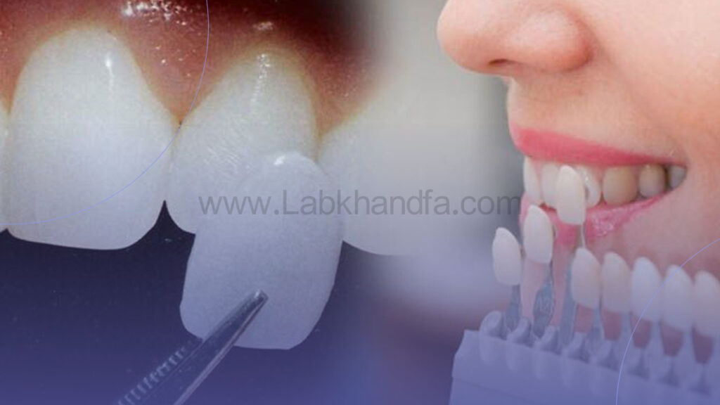 لمینت دندان