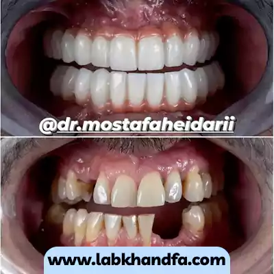 نمونه درمان جایگزین دندان از دست رفته با کاشت ایمپلنت توسط دکتر مصفطی حیدری