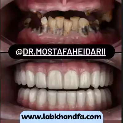 نمونه درمان کاشت ایمپلنت دندان توسط دکتر مصطفی حیدری