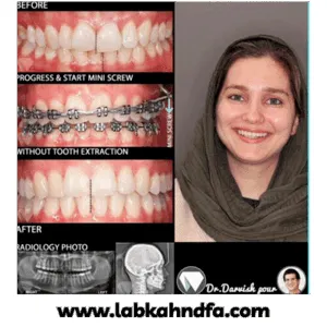 نمونه کار ارتودنسی ثابت دکتر هادی درویش پور