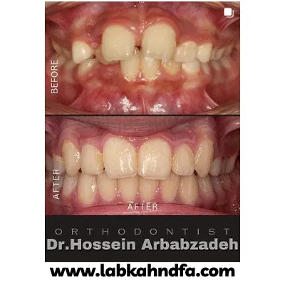نمونه کار ارتودنسی دکتر حسبن ارباب زاده بروجنی