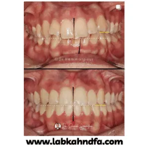 نمونه کار ارتودنسی دکتر سیامک همت پور