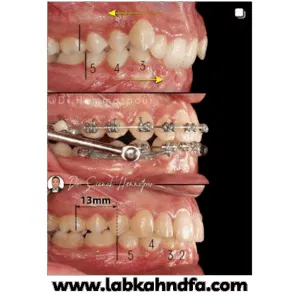 نمونه کار ارتودنسی دکتر سیامک همت پور شماره 2