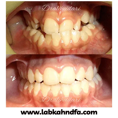 نمونه کار ارتودنسی دکتر علی حیدری