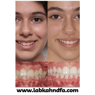 قبل و بعد نمونه کار ارتودنسی کودکان دکتر محمد فراهانی