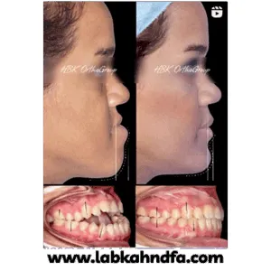 نمونه کار ارتودنسی دکتر سیامک همت پور شماره 1