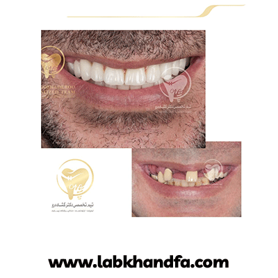 نمونه کار ایمپلنت دکتر عزیز گشاده رو