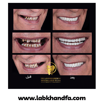 نمونه کار ایمپلنت دکتر عزیز گشاده رو