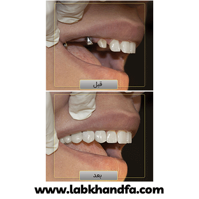 نمونه کار ایمپلنت دکتر وحید دهقان