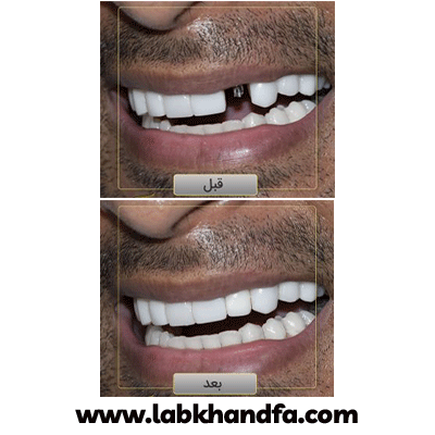 نمونه کار ایمپلنت دکتر وحید دهقان