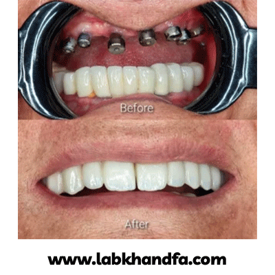 نمونه کار ایمپلنت دکتر وحید سعیدیان شماره 1