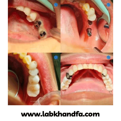 نمونه کار ایمپلنت دکتر وحید سعیدیان