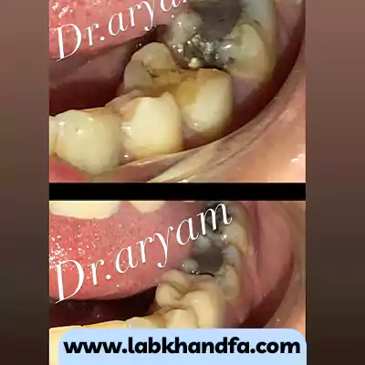 نمونه کار درمان پوسیدگی عمیق دندانی توسط دکتر میثم آریام