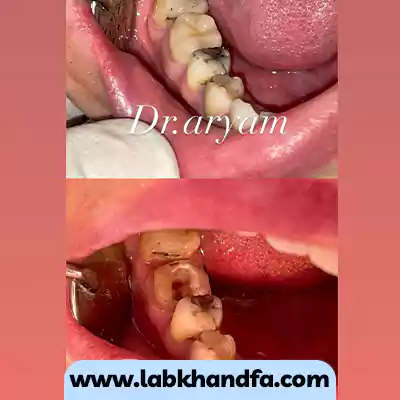 نمونه کار عصب کشی و نصب روکش دندانی توسط دکتر میثم آریام