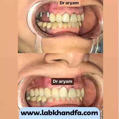 نمونه کار کاشت 2 واحد ایمپلنت دندانی توسط دکتر میثم آریام