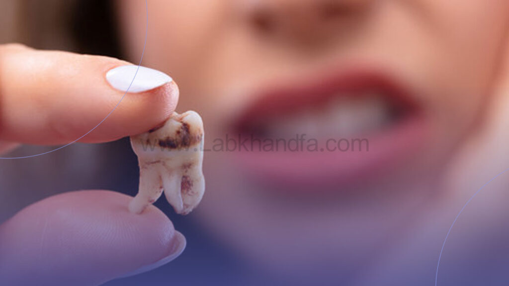 پوسیدگی دندان