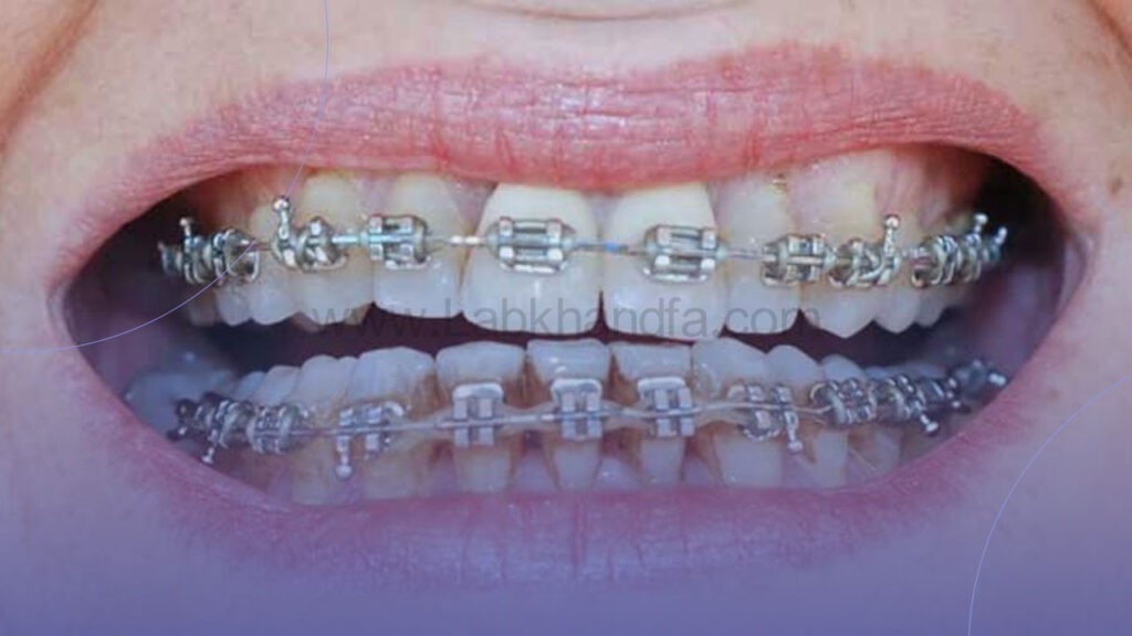 پوسیدگی دندان در ارتودنسی