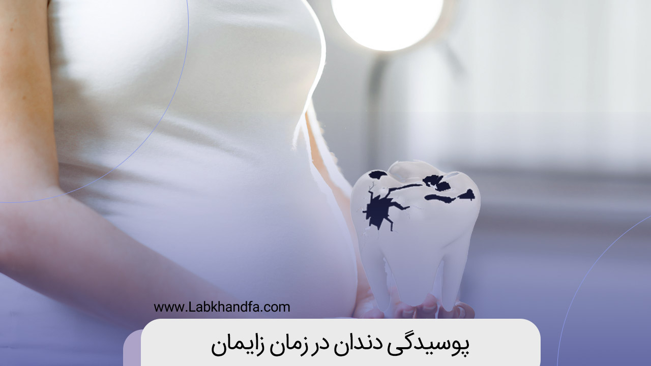 پوسیدگی دندان در زمان زایمان