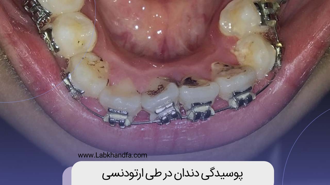 پوسیدگی دندان در طی ارتودنسی