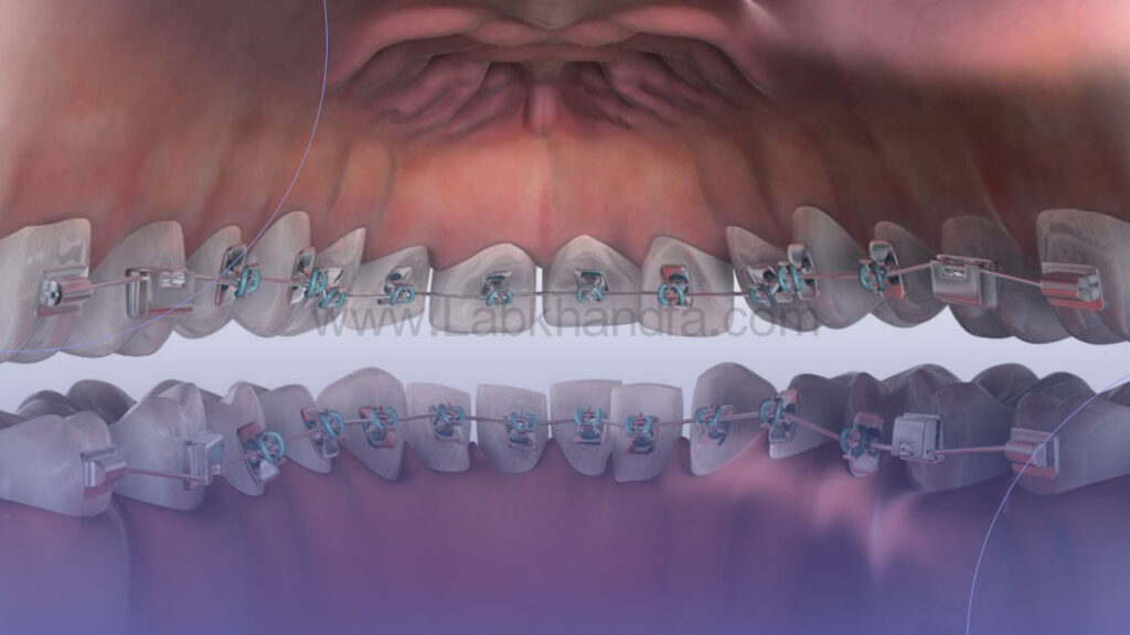 ارتودنسی لینگوال