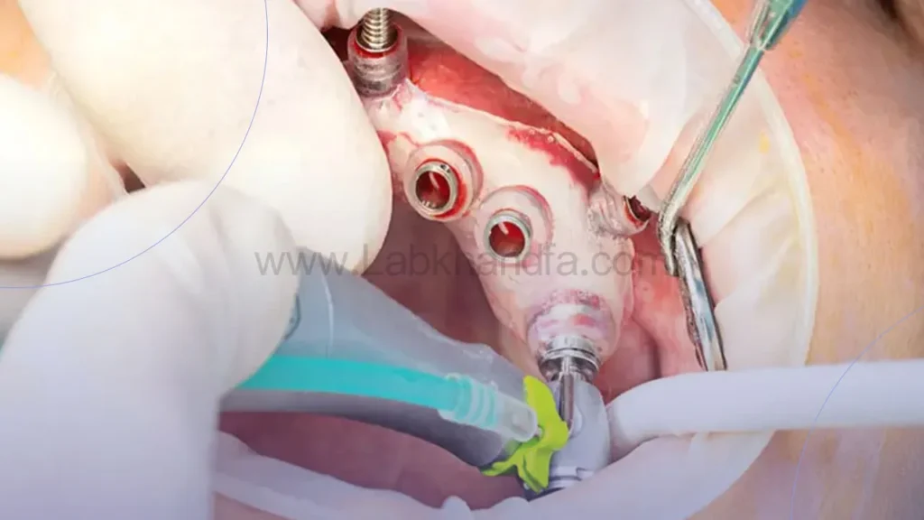 عکسی از کاشت ایمپلنت دیجیتال