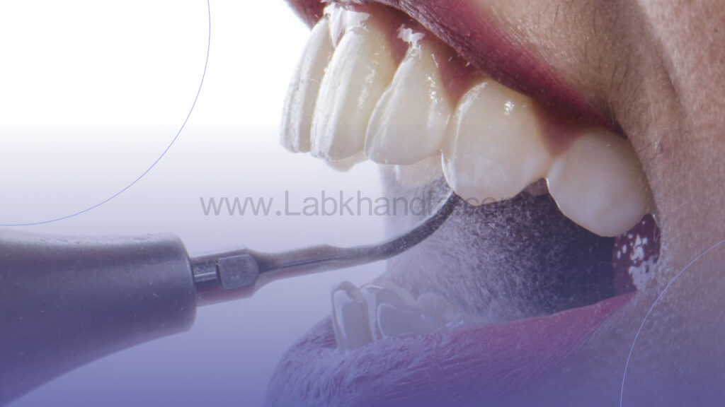 عکس جرم گیری دندان