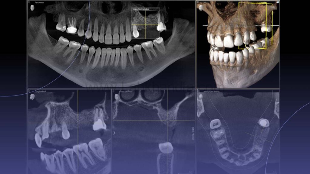 عکس رادیوگرافی دندان