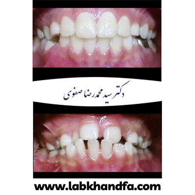 نمونه کار درمان ارتودنسی دکتر سید محمدرضا صفوی