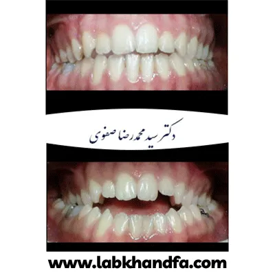 نمونه کار دیگری از ارتودنسی دکتر سید محمدرضا صفوی