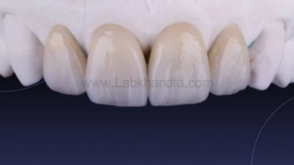 عکسی از لمینت سرامیکی IPS