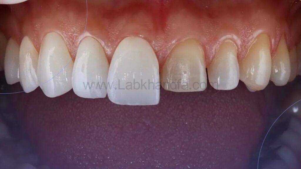 عکسی از لمینت سرامیکی زیرکونیا