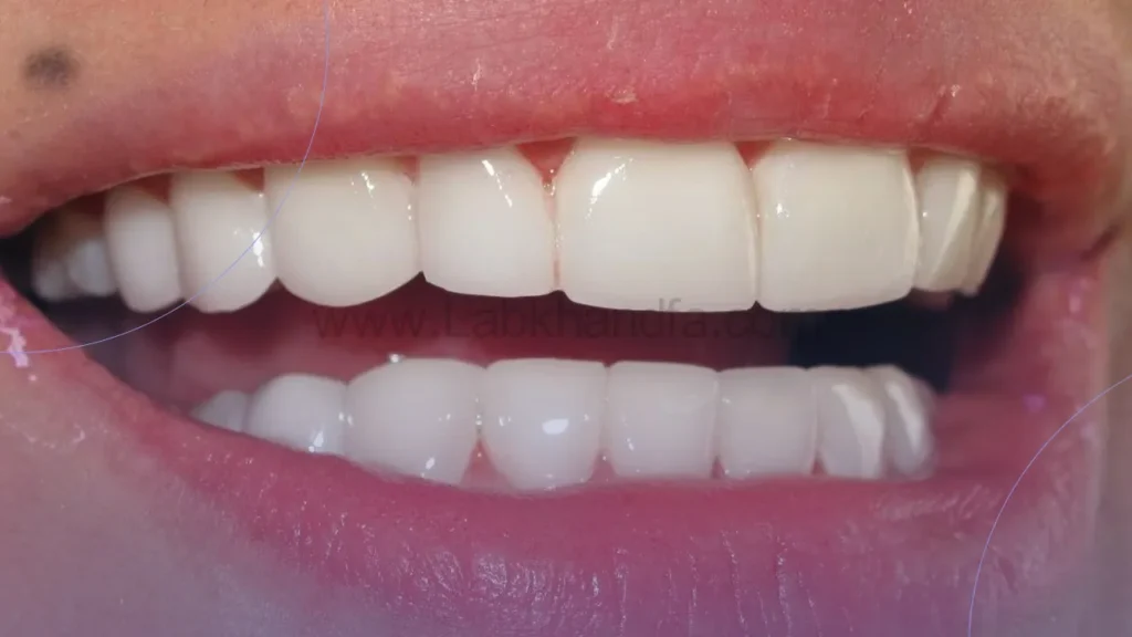 عکسی از لمینت دندان لومنیرز