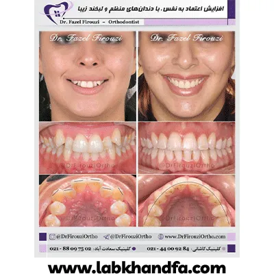 قبل و بعد نمونه کار درمان ارتودنسی دکتر فاضل فیروزی شماره 1