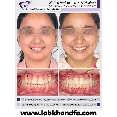 قبل و بعد نمونه کار درمان ارتودنسی دکتر فاضل فیروزی شماره 2