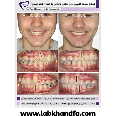 قبل و بعد نمونه کار درمان ارتودنسی دکتر فاضل فیروزی شماره 1