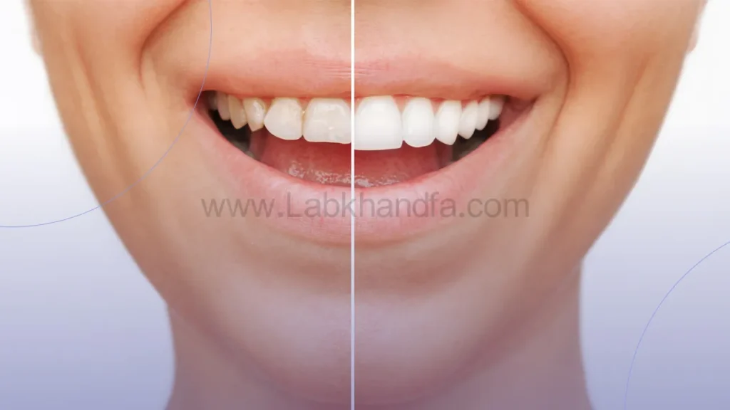 تصویری از لمینت دندان فلدسپاتیک