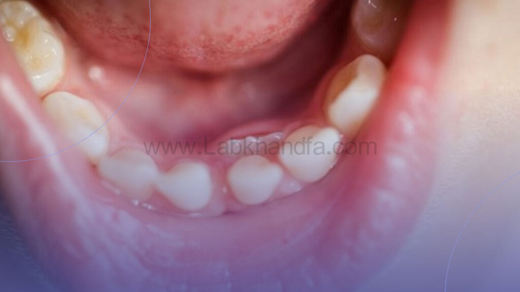 دندان کوسه ای کودکان