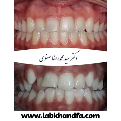قبل و بعد نمونه کار ارتودنسی دکتر سید محمدرضا صفوی