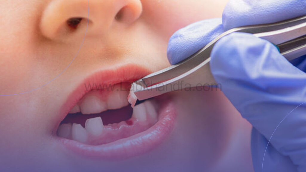 کشیدن دندان شیری