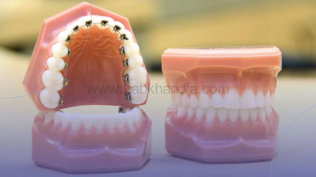 ارتودنسی پشت دندانی