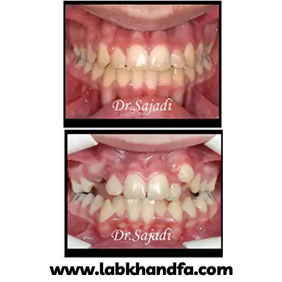 درمان ارتودنسی ثابت دندان نیش نهفته توسط دکتر سودابه سجادی