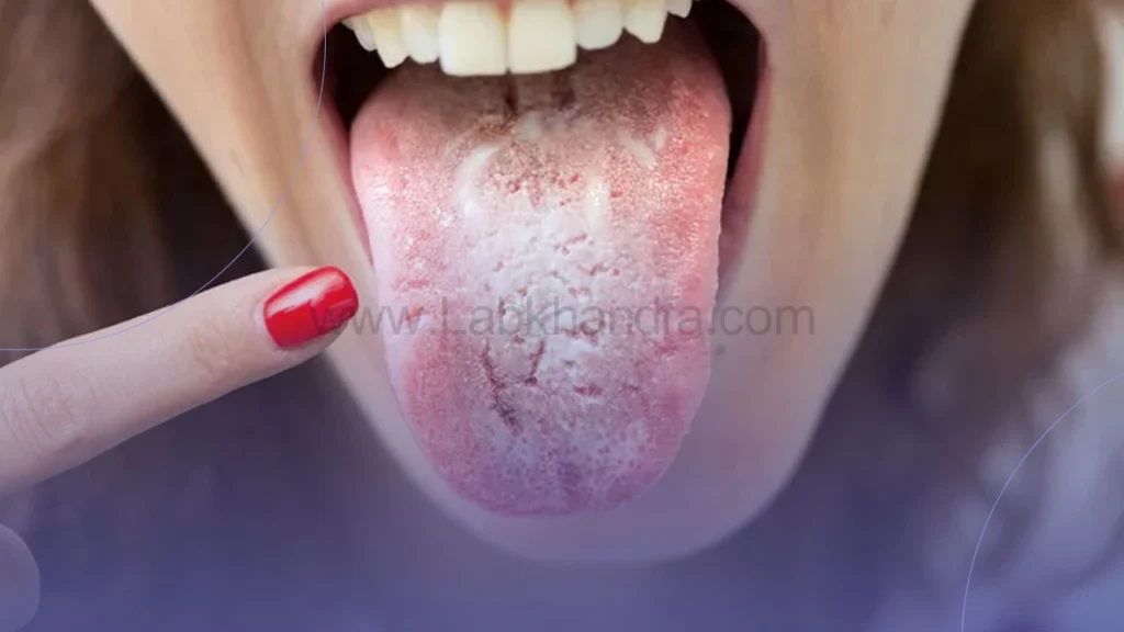 سفید شدن زبان