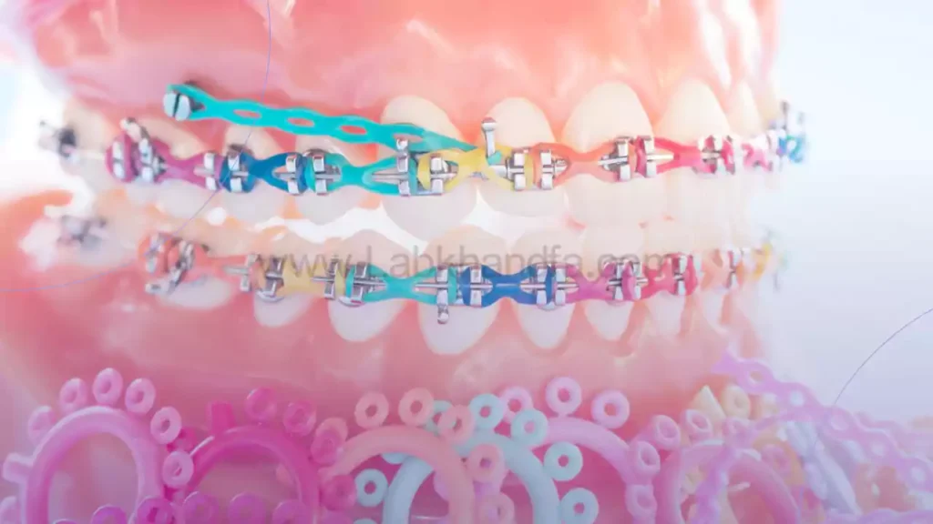 عکسی از کش و بریس های ارتودنسی رنگی