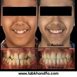 عکس قبل و بعد ارتودنسی دکتر الهام هرمزی