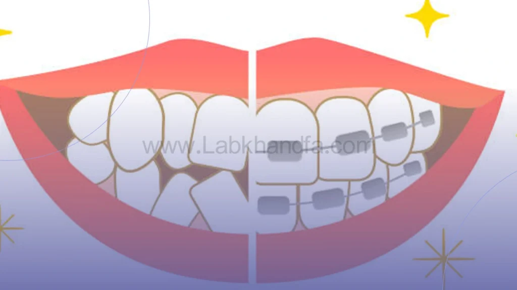 مرتب کردن دندان ها با ارتودنسی