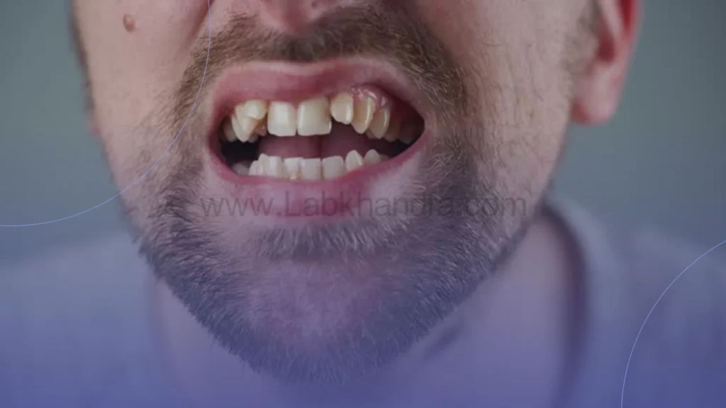 نامنظمی شدید دندان ها