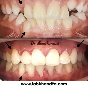 نمونه کار ارتودنسی دکتر الهام هرمزی