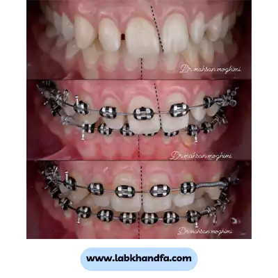 نمونه کار ارتودنسی دکتر مهسان مقیمی